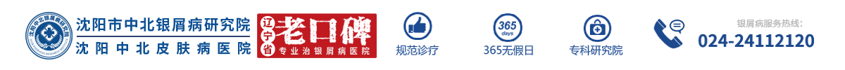 「沈陽中北牛皮癬醫院」-沈陽牛皮癬?？漆t院-沈陽銀屑病醫院哪個正規-沈陽看效果好的銀屑病